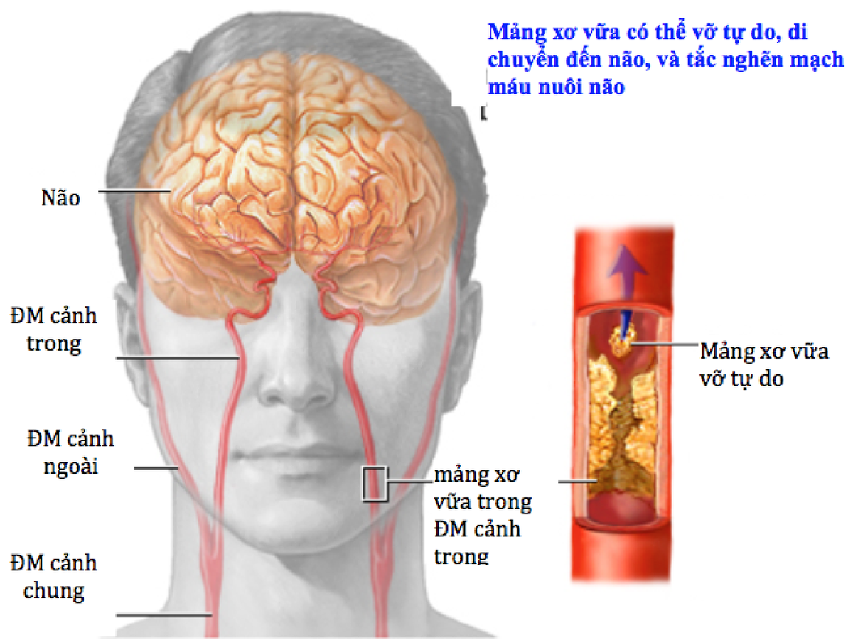 Top 5: Hậu quả nghiêm trọng ảnh hưởng tới sức khỏe lâu dài của các cầu thủ từng trải qua cơn đau tim hoặc thiếu máu não thoáng qua khi thi đấu
